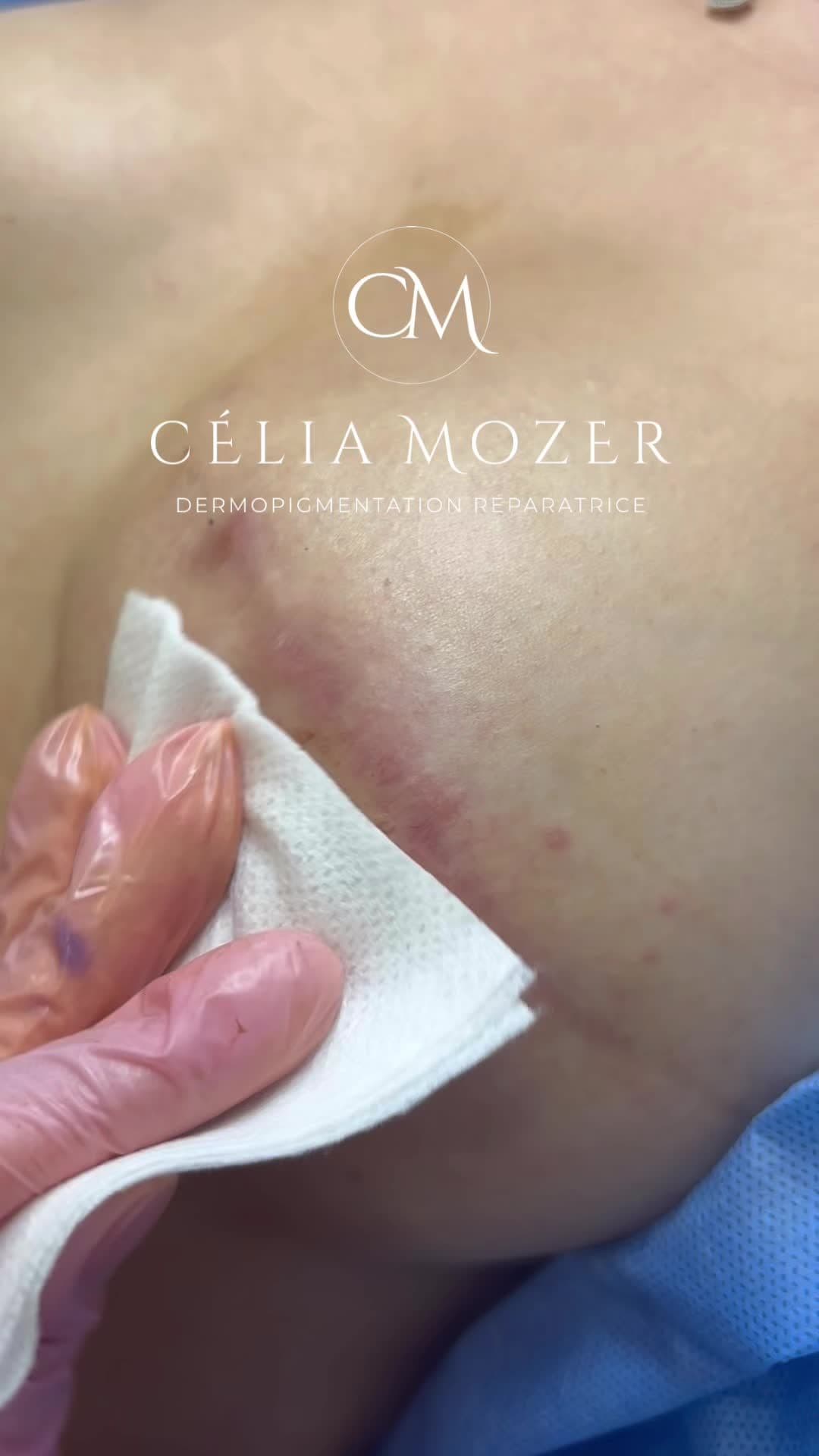 Ceci est un tatouage post cancer du sein 🎗️ / NE PAS SUPPRIMER  This is a post breast cancer tatoo 🎗️/ DO NOT BAN  Aréole mammaire effet 3D hyper réaliste ✨ #fyppppppppppppppppppppppp #fyp #foryourpages #tatouagefemmes #breastcancerwarrior💕 #cancerdusein #tatoo #pmuartist #pmu #areola 